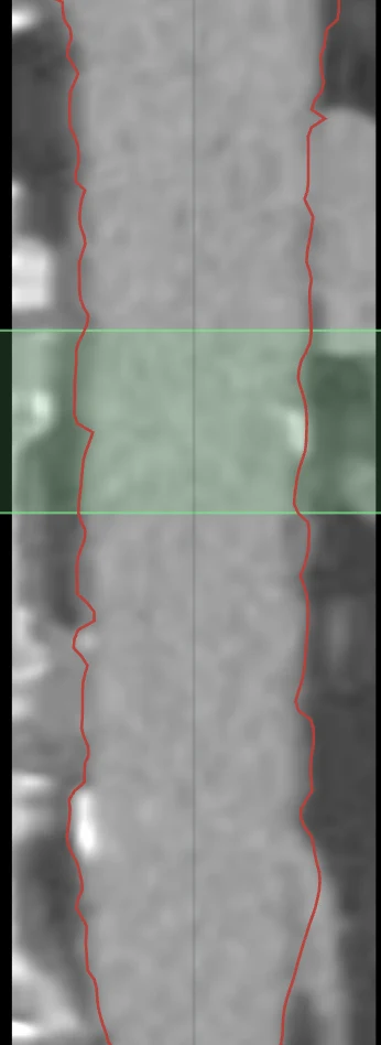 Curved planar reformation (CPR) of the aorta with the lumen contour