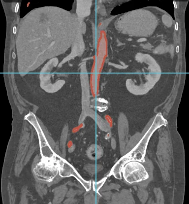 Coronal CT slice with the aorta highlighted